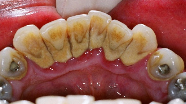 Lấy cao răng giúp răng sạch khỏe và ngăn ngừa nhiều bệnh lý nguy hiểm