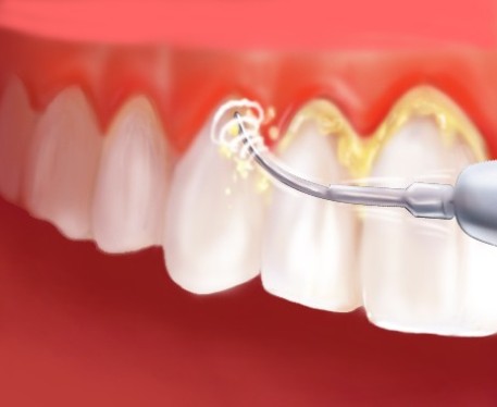 Cao răng là gì? Tại sao phải lấy cao răng?